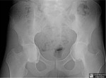 Acetabular Protrusio